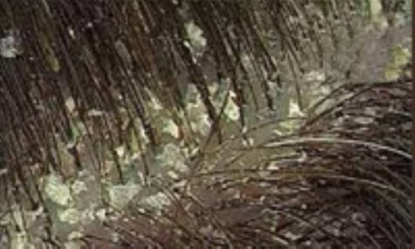 راه خلاص شدن از شوره و چربی پوست سر